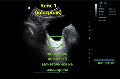 Кейс 1. УЗИ контрольное